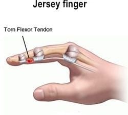 Fdp Tendon Hand / Flexor Tendon Injuries / This muscle extends from the